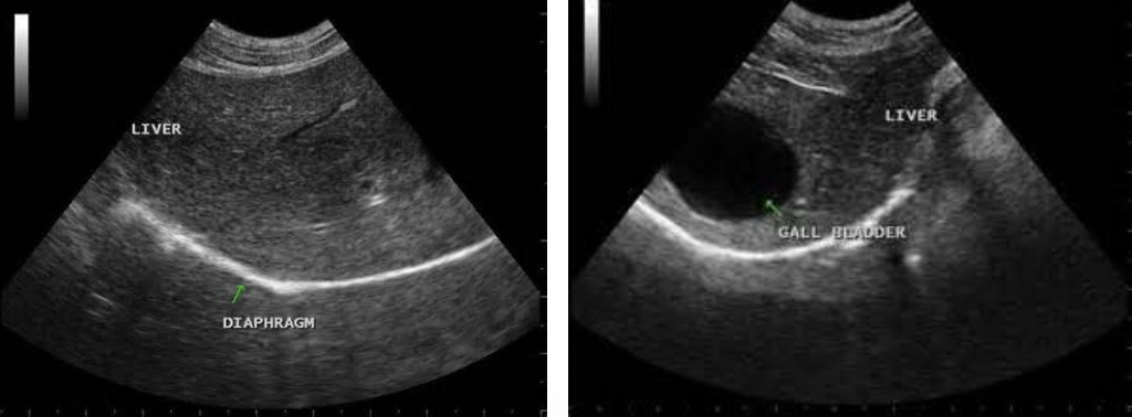 <ul><li><p>coarsely grained </p></li><li><p>large vessels, gallbladder is visible</p></li><li><p>diaphragm lies beneath the liver</p></li><li><p>portal veins have clearly defined, bright, hyperechoic walls</p></li><li><p>hepatic veins have poorly defined walls</p></li><li><p>Function:</p></li></ul><p>- digestion and absorption of nutrients </p><p>- synthesizing nutrients and regulating their release into the bloodstream </p><p>- excreting toxic substances </p><p>- producing most plasma proteins, cholesterol, and many of the blood coagulation factors</p><p></p>