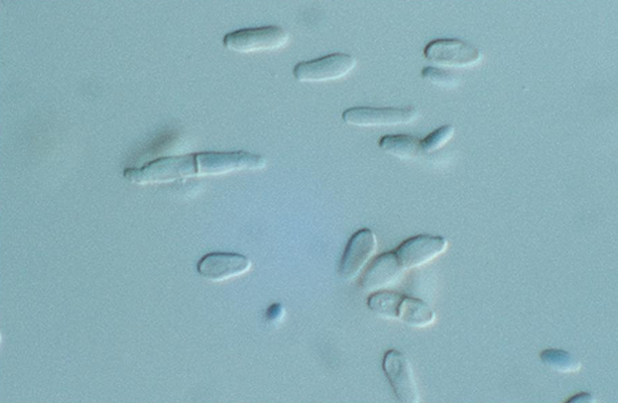 <p>Tinea nigra, characterized by brown to black nonscaly macules that occur most often on the palms and soles.</p>