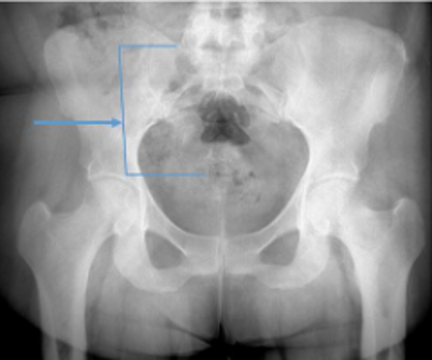 <p>What is the anatomical structure in between the lines?</p>