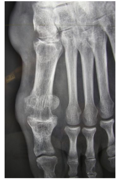 <ul><li><p>pincement global 1ere MTP </p></li><li><p>Érosions multiples </p></li><li><p>Tophus sous-cut </p></li></ul><p></p>