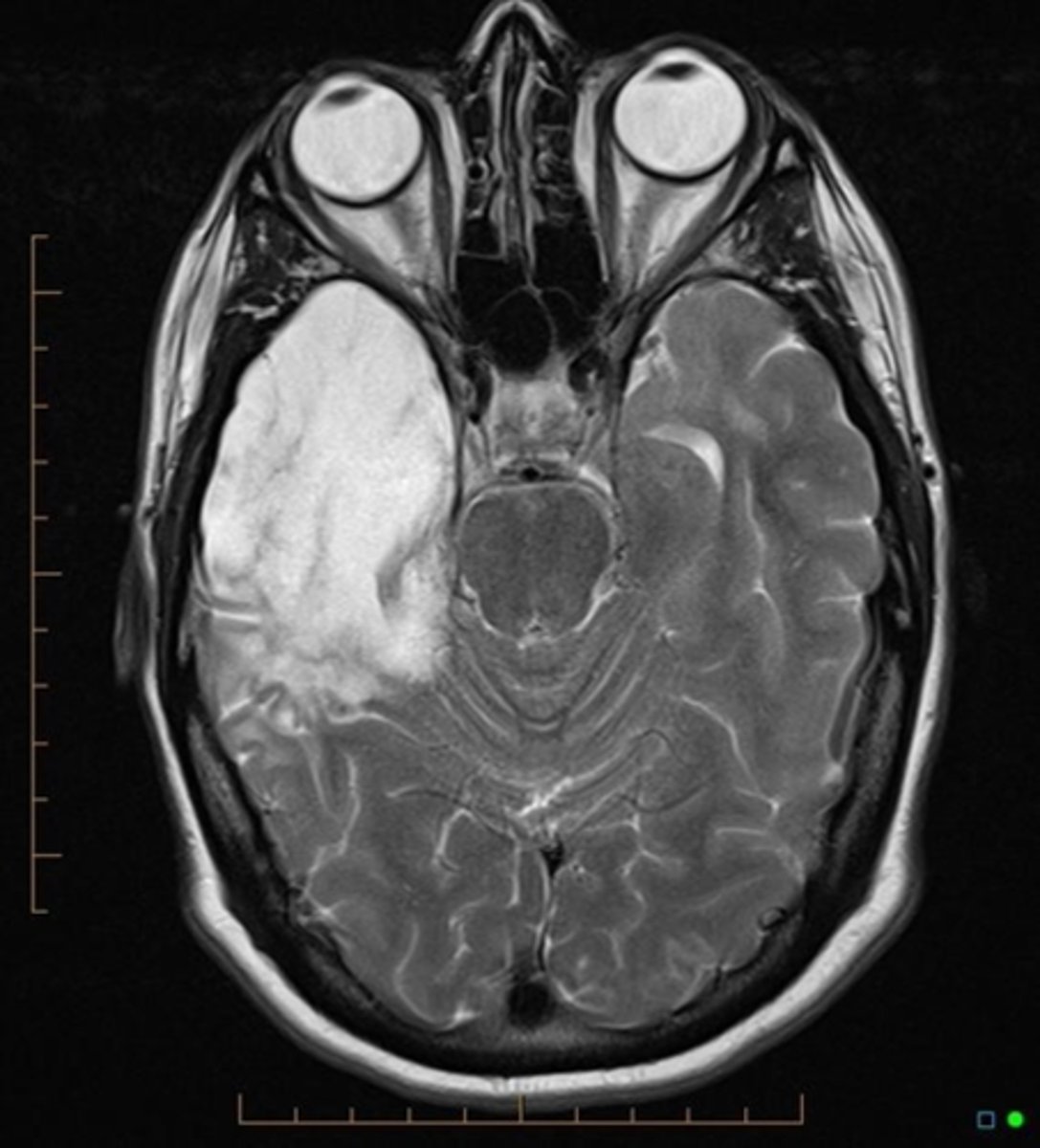<p>virus spreads to the brain (by both HSV-1 and HSV-2)</p><p>high death rates (up to 70% by HSV2 if not treated)</p><p>Treated with acyclovir</p>