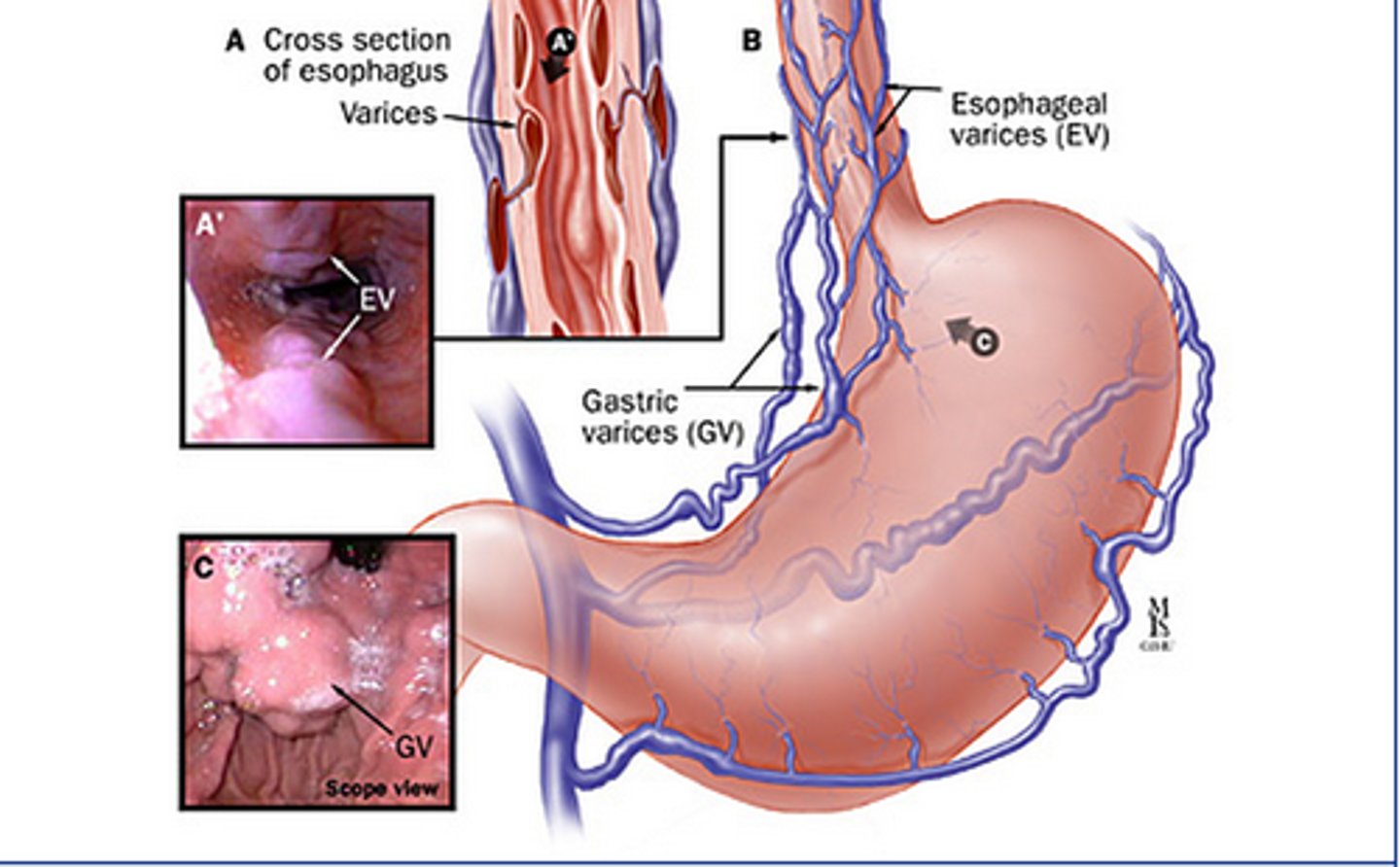 <p>false. esophageal varices are pathophysiologies seen in impaired blood INflow and impaired INTRAhepatic blood flow. its usually due to the shunting of blood in the portal system back to organs.</p>