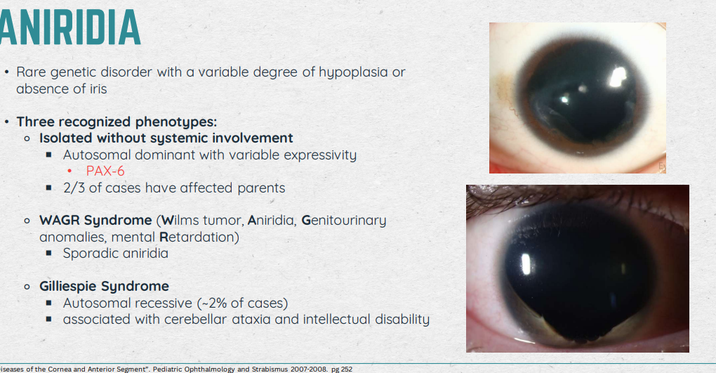 <ul><li><p>Usually autosomal dominant w/o any system involvement in the PAX-6 gene</p></li><li><p>If first to see the Pt, do bloodwork/genetic testing to see what’s causing this</p></li><li><p>Present in: Foveal hypoplasia → nystagmus</p></li><li><p>Acuities range: 20/100 - 20/200</p></li><li><p>Management: Make them comfy; co-manage with opthalmology; genetic counseling; low vision (tints/devices); refractive error/amblyopia management</p></li></ul><p></p>