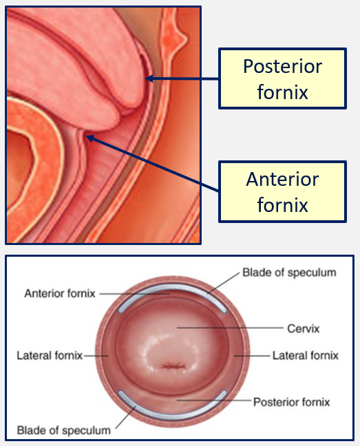 <p>When the vagina recesses around the cervix, small folds anteriorly and posteriorly to the cervix</p><p>These folds are the vaginal fornices </p><ul><li><p>One anterior fornix</p></li><li><p>One posterior fornix</p></li></ul><p></p>