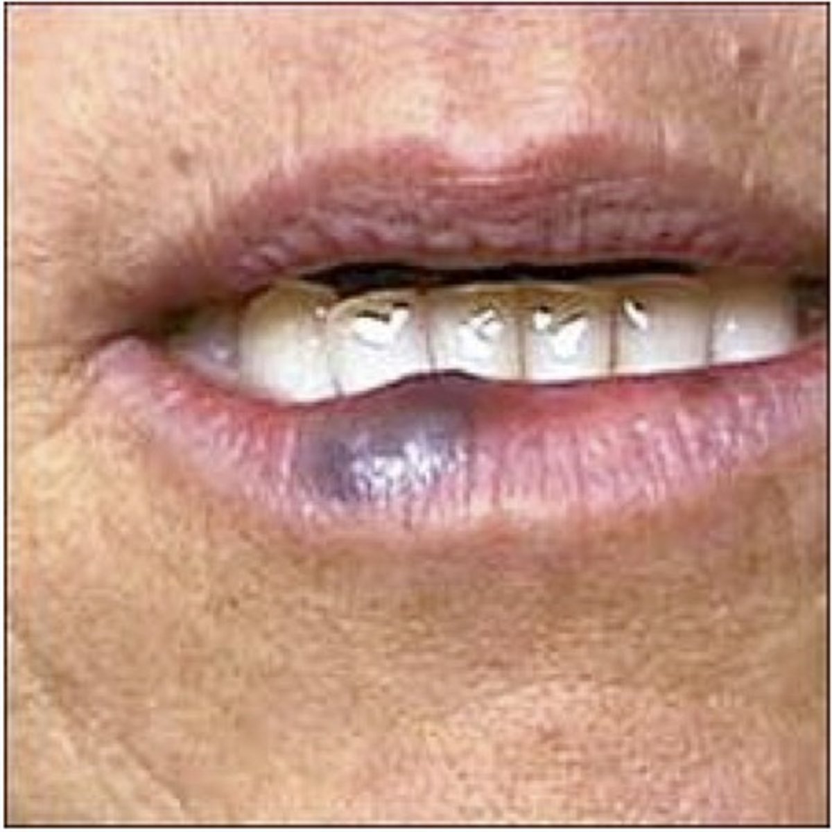 <p>from a hard bite or fall</p>