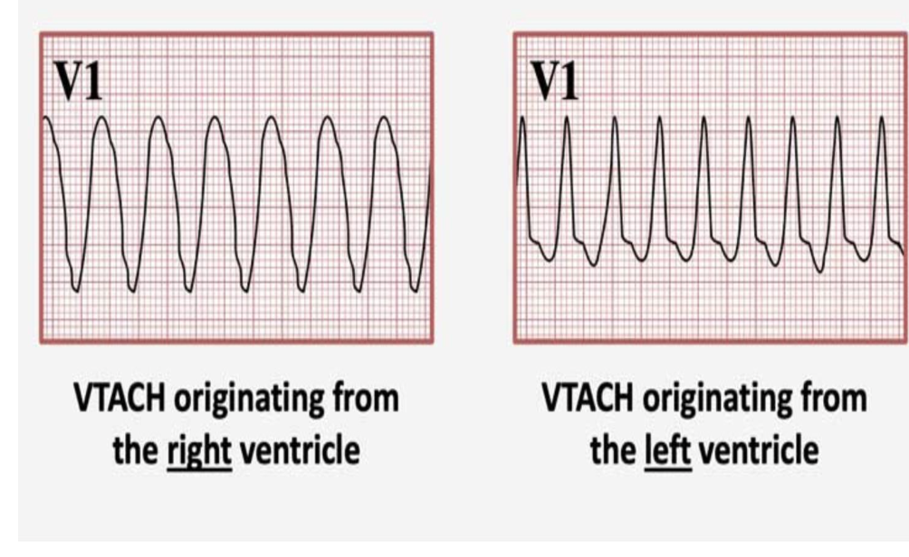 <p>Wide QRS</p><p>regular rapid rhythm</p><p>life thretannig</p><p>originates from the right or left ventricle&nbsp;</p><p>needs cpr immediatly</p><p></p>