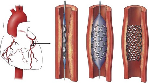 <p>A small object inserted into a blood vessel to open it up and keep it open.</p>