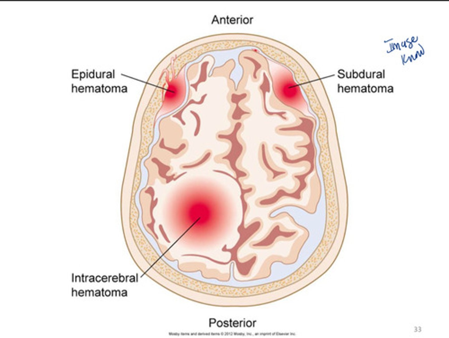 <p>Epidural (extradural) hematoma</p><p>Subdural hematoma</p><p>Intracerebral hematoma</p>