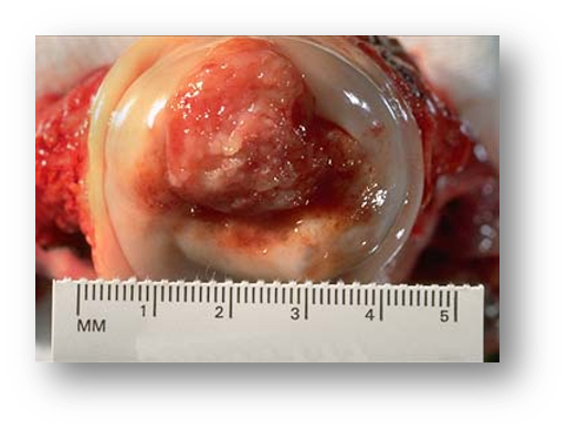 The etiology of this lesion is 