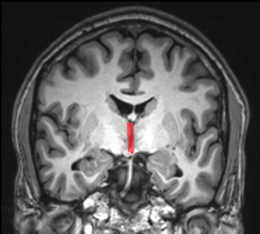 <p>midline cavity found in diencephalon</p><p>connects with 4th ventricle via cerebral aqueduct</p><p>contains choroid plexus</p><p>lateral walls: hypothalamus (inf) and thalamus (sup)</p>