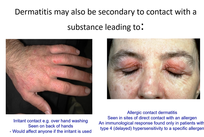 <ol><li><p><strong>Irritant contact </strong>e.g.. over hand washing - can affect anyone </p></li><li><p><strong>Allergic contact dermatitis - </strong>only found in patients who have a hypersensitivity to a specific allergen </p></li></ol><p></p>