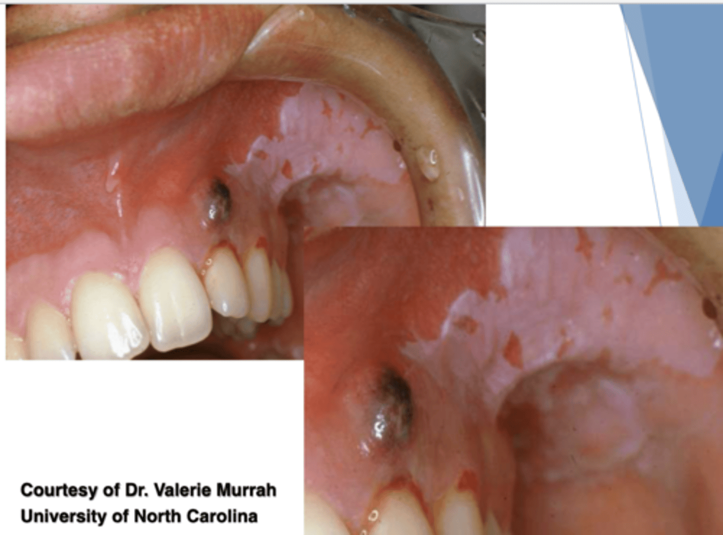 <p>what are some common factitial medicaments that can cause chemical injury within the oral cavity? (3)</p>