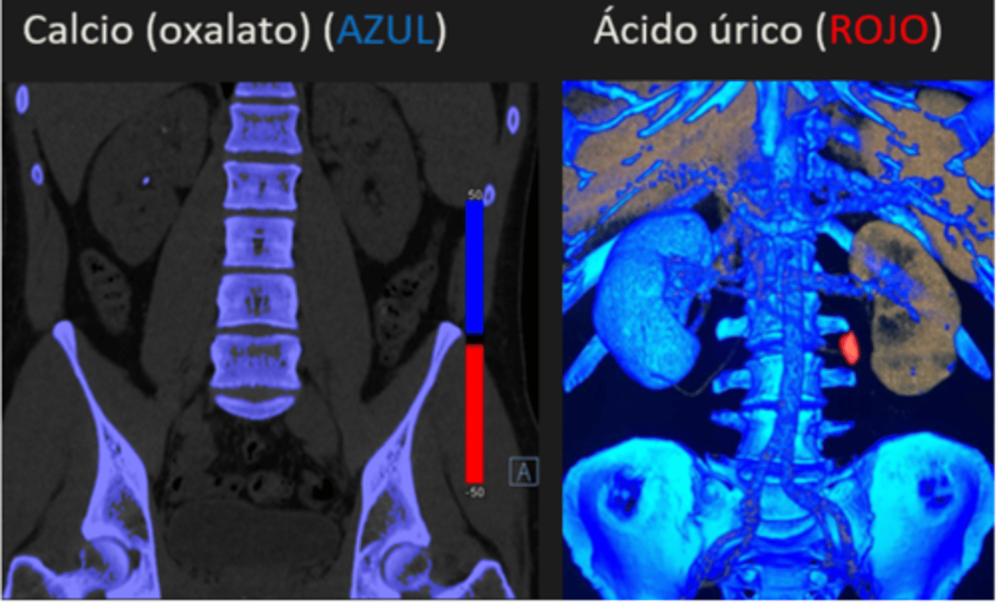 <p>Un estudio que usa dos voltajes distintos para diferenciar la composición de los cálculos.</p>