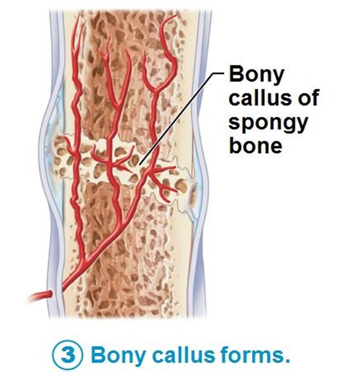 <p>3rd step in healing a broken bone: osteoblasts fill spongy bone with osteoid to create compact bone patch</p>