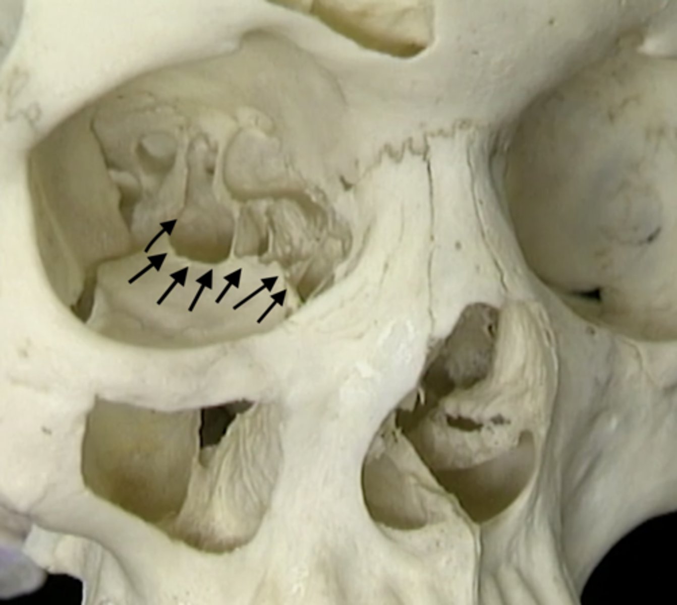 <p>space behind the bones</p><p>pinch the bridge of the nose</p>