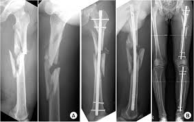 <p>The bone is broken into 3 or more fragments - common in long bones such as the femur</p>