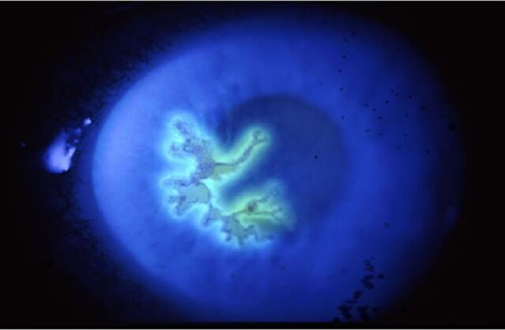 showing a dendritic ulcer