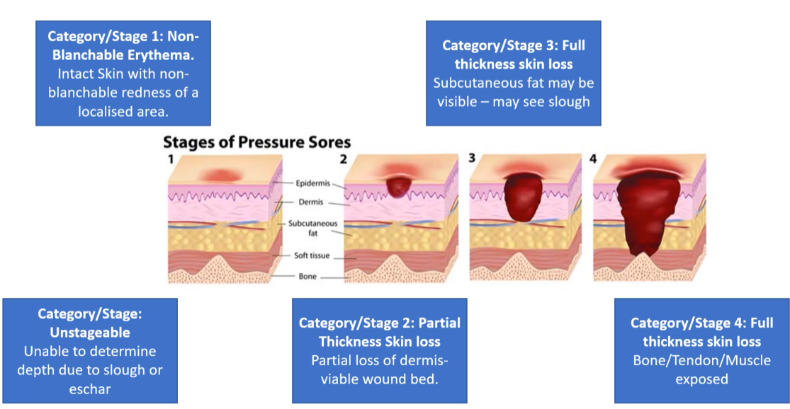 <ul><li><p>Stage 1: Non-blanchable erythema</p></li><li><p>Stage 2: Partial thickness skin loss</p></li><li><p>Stage 3 &amp; 4: Full thickness skin loss&nbsp;</p></li></ul><p></p>