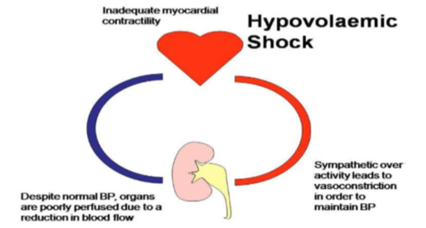 <p>2 phases:</p><p>1. hypovolemic shock</p><p>2. hypermetabolic state (hypervolemic)</p><p>overall a metabolic crisis in the body!</p>