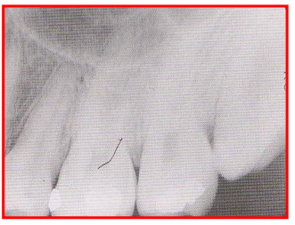 <ul><li><p>Image appears stretched and distorted</p></li><li><p>Fix: avoid bending film excessively either from heavy finger pressure or curvature of the palate → use cotton rolls to prevent too much bending. </p></li></ul><p></p>