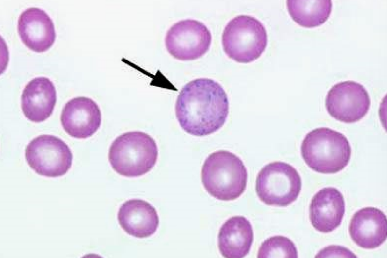 * Nx in anemic Rums, good sign bc responding to anemia
* Lead toxicity