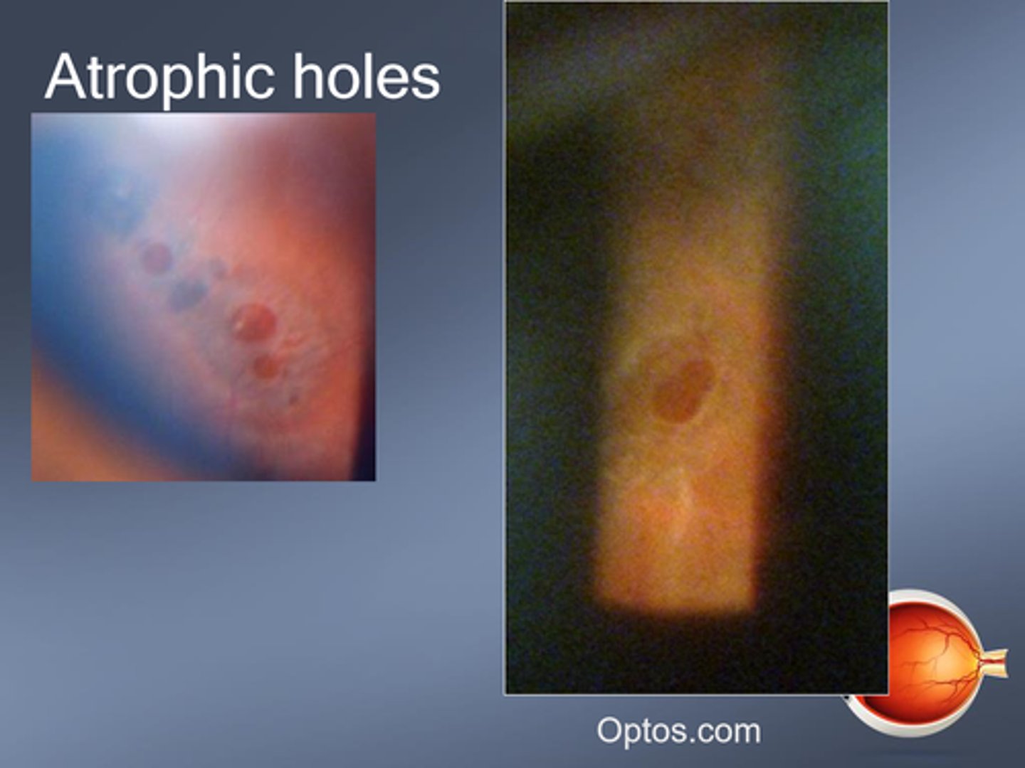 <p>pigment around hole = reactive RPE hyperplasia</p>