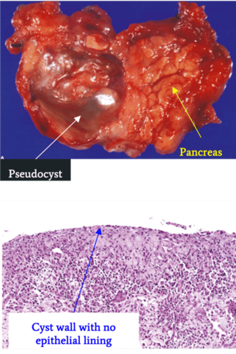 <p>Define Condition:</p><p>Encapsulated collection of fluid formed by fibrous/granulation tissue surrounding liquefactive necrosis and pancreatic enzymes (no epithelial lining of cyst)</p><p>-Hx: Weeks after episode of Acute Pancreatitis</p><p>-Prog: Usually resolves spontaneously but may be infected &amp; ruptured --&gt; release of enzymes into abdominal cavity</p>