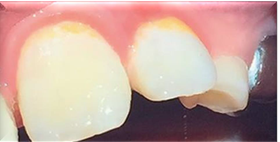 <p>What causes gray/brown staining?</p>