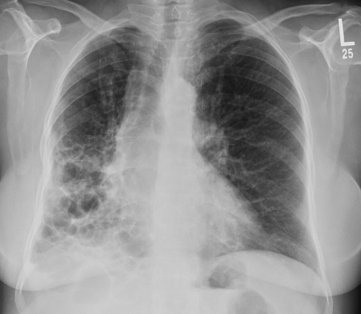 <p>Bronchiectasis </p>