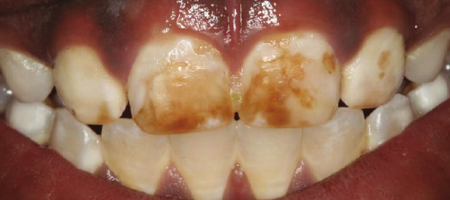 <p>hypomineralization due to &gt; 2ppm fluoride ingestion during mineralization</p>