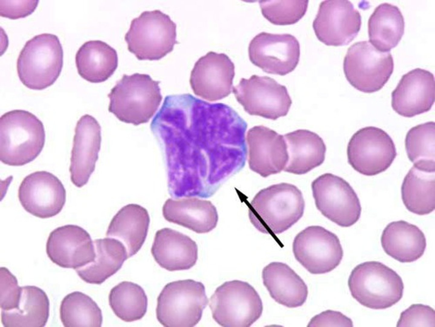 <p>-neoplastic cells show a cerebriform appearance on morphology</p>