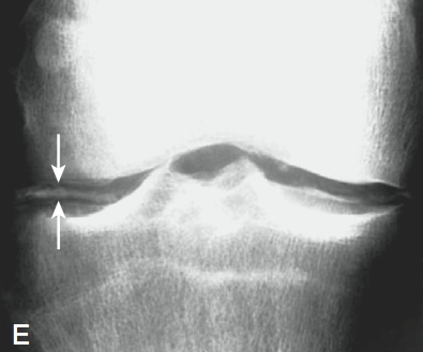 <p>Calcification of the articular cartilage</p>