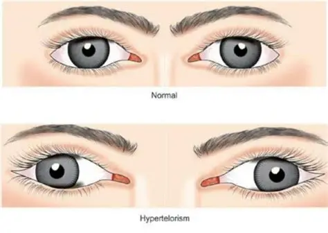 <p>term for wide spaced eyes </p>