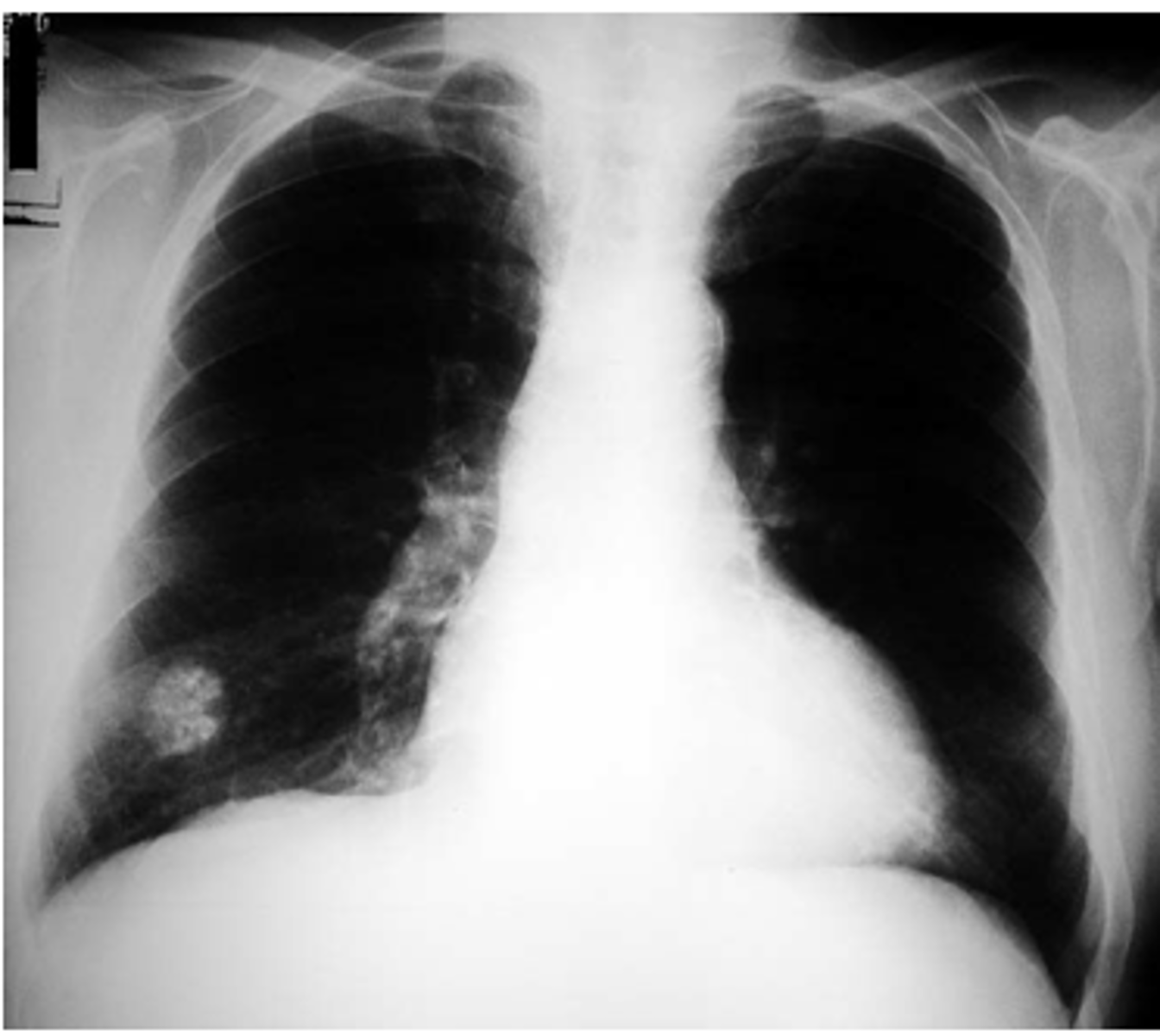 <p><b>hamartomas</b><br>peripheral <b>popcorn calcifications</b> on CXR <br>-only tx is surgery but HIGHLY VASCULAR so only remove if causing problems!<br><br>-other common benign mass are bronchial adenomas</p>
