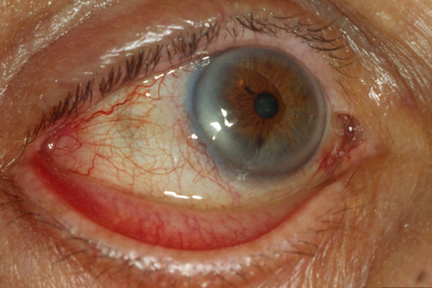<p>Ectropion; may result in excessive tearing</p>