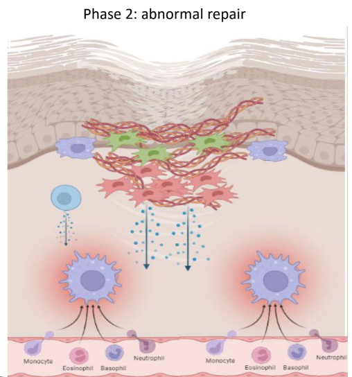 <ul><li><p>Overactivated local structural cells (<span style="color: green;"><strong>like fibroblasts</strong></span>) </p></li><li><p><strong>Lead to increased motility and tissue accumulation</strong></p></li><li><p><strong>Overproduction and deposition of ECM</strong> causing fibrosis and tissue strictures</p></li><li><p><strong>Excessive epithelial damage </strong><span style="color: red;"><strong>causing ulcerations or fistulas.</strong></span></p></li></ul><p></p>