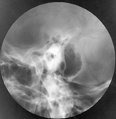 <p>What is this x-ray demonstrating?</p>