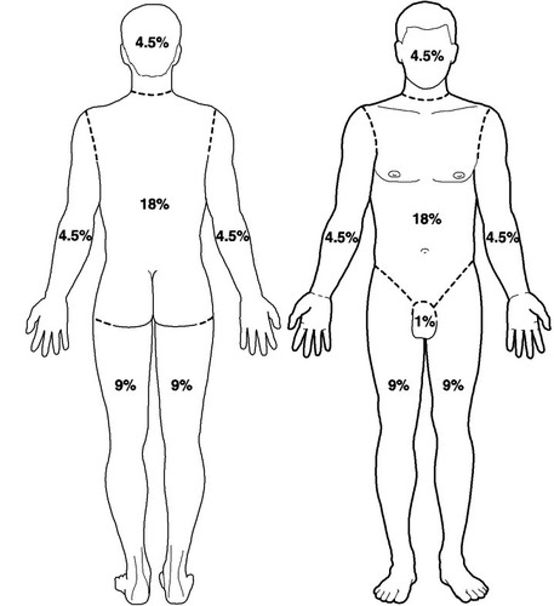 <p>way to determine the extent of burns. 25-30% is considered a major burn.</p>