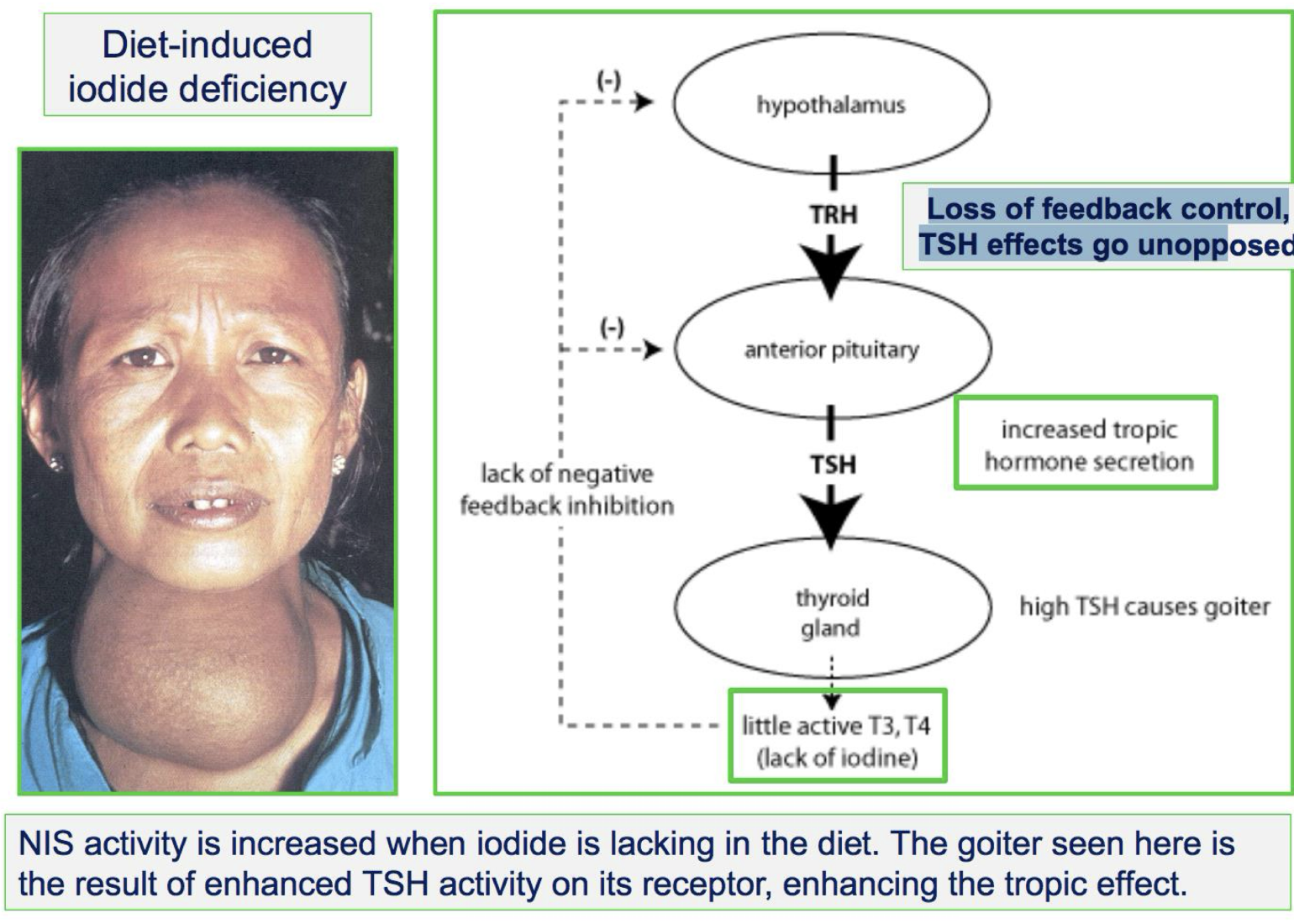 <ul><li><p>goiter, enlarged thyroid gland bc Increases uptake of iodide causing goiter</p></li></ul><p>Other signs include mental impairment and brain</p><p>damage, irreversible if not treated</p><p> During pregnancy, leads to cretinism</p><p>Goiter—> Continued deficiency</p><p> Cretinism—> Severe deficiency in pregnancy, Irreversible physical and mental retardation</p><p></p>
