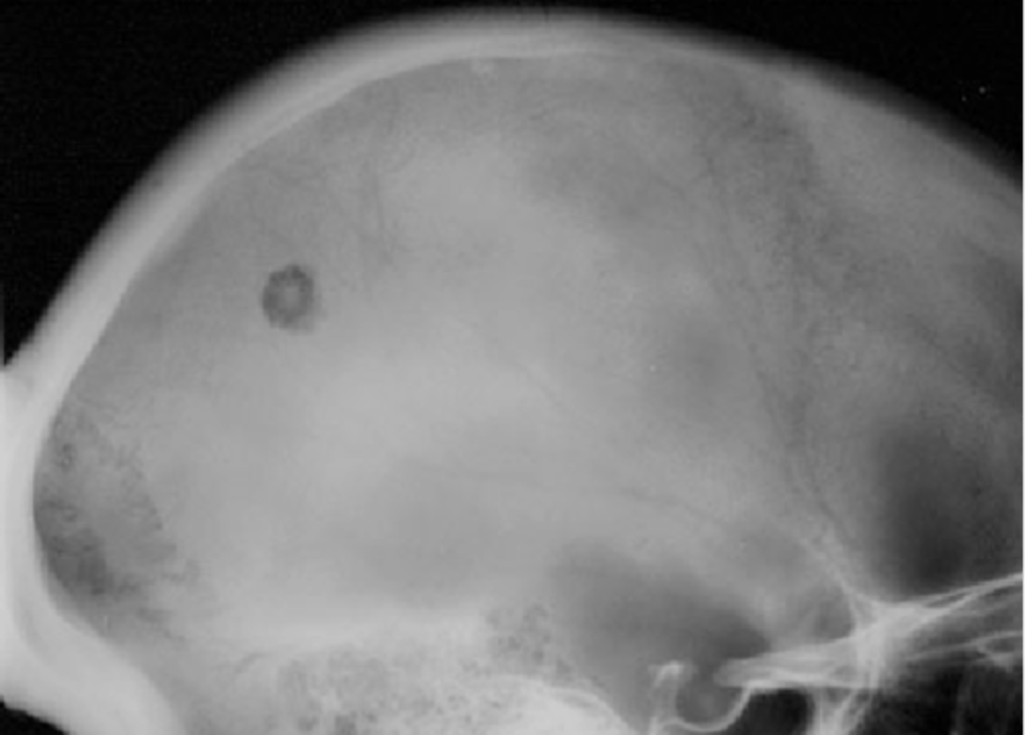 <p>ID radiographic feature of eosinophilic granuloma in the skull</p>