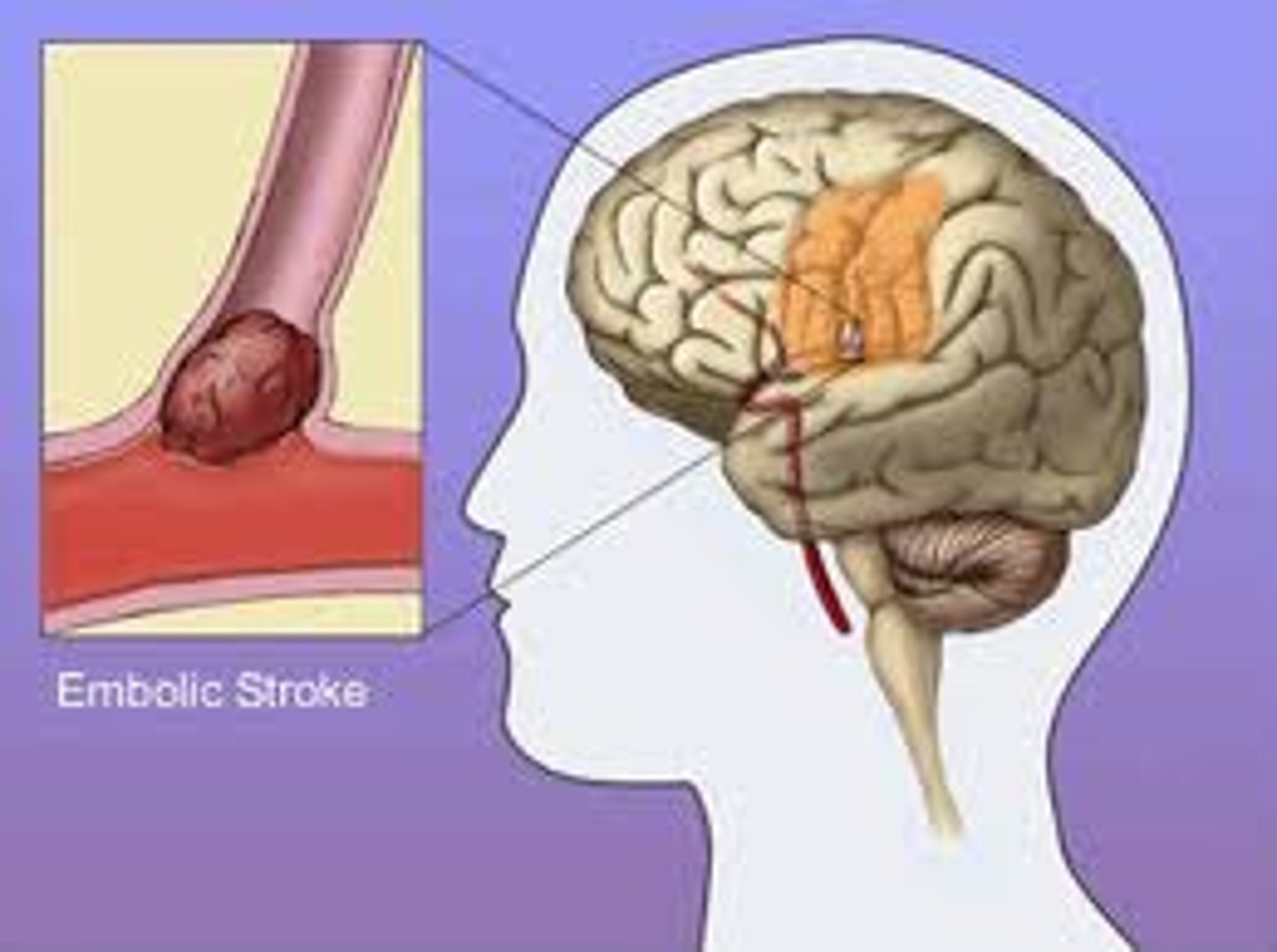 <p>blood clot forms and travels through the bloodstream to the brain, the clot eventually lodges in a blood vessel and blocks the blood flow</p>