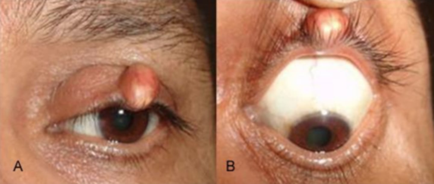 <p>calcium deposition = granulomatous response = slow growing, hard, benign tumor of lash hair bulb = typically reddish surround with whiteish calcium nodules</p>