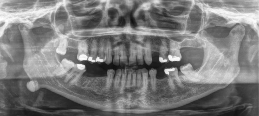 <p>Well circumscribed radiopaque lesion</p>