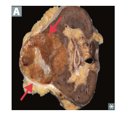 Well- circumscribed mass with central scar