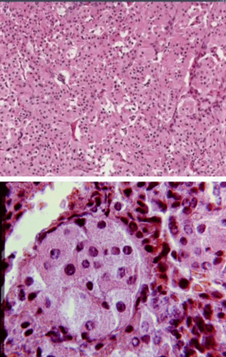 <p>Large polyhedral cells with abundant granular cytoplasm</p><p>▫ Mitochondria</p><p>Cells are separated by thin fibrous septal</p>