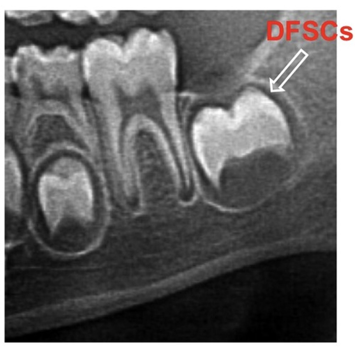 <p>ectomesenchymal stem cells found in the dental follicle (surrounding of the tooth germ) of developing tooth bud --&gt; can differentiate into osteoblasts, adipocytes, chrondrocytes, &amp; neuronal cells</p>