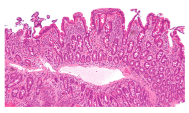 <p>what disease is this the histology of?</p>