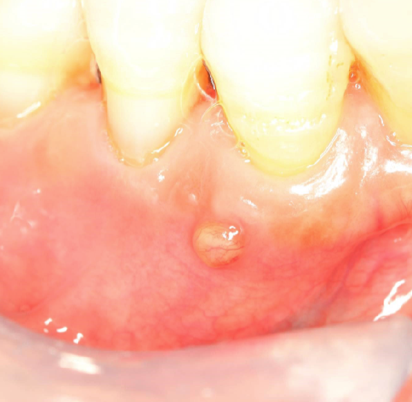 <ol><li><p>dome-shaped yellow-pink papule</p></li><li><p>may/may not exhibit active suppuration (pus formation) </p></li></ol><p></p>