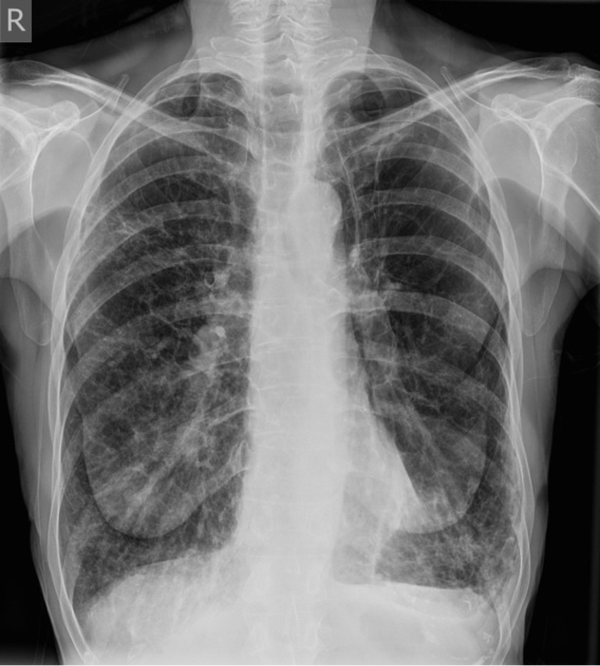 <p>Pulmonary function test resultsChronic Bronchitis</p>