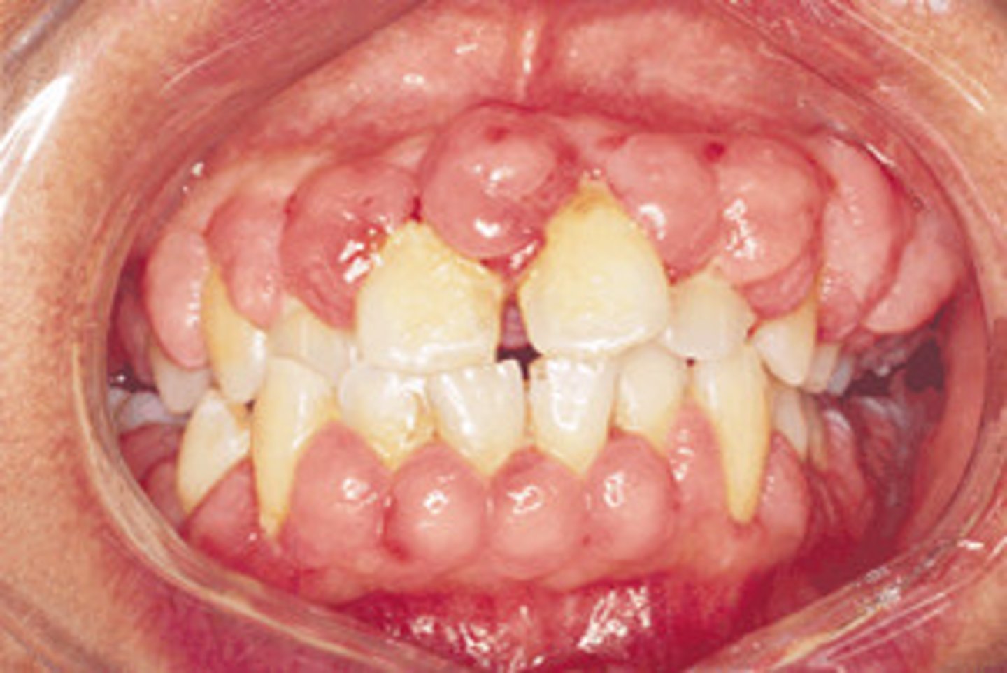 <p>response to chronic inflam</p><p>idiopathic</p><p>drug reaction</p><p>hormonal changes</p><p>genetic</p>